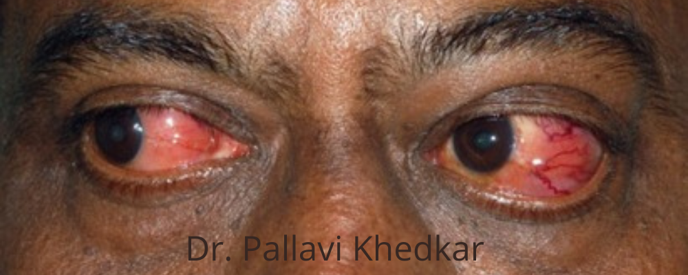 Eye Plastic Surgeon in Aurangabad- Dr. Pallavi Khedkar