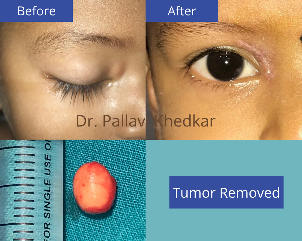 Eye Plastic Surgeon in Aurangabad- Dr. Pallavi Khedkar