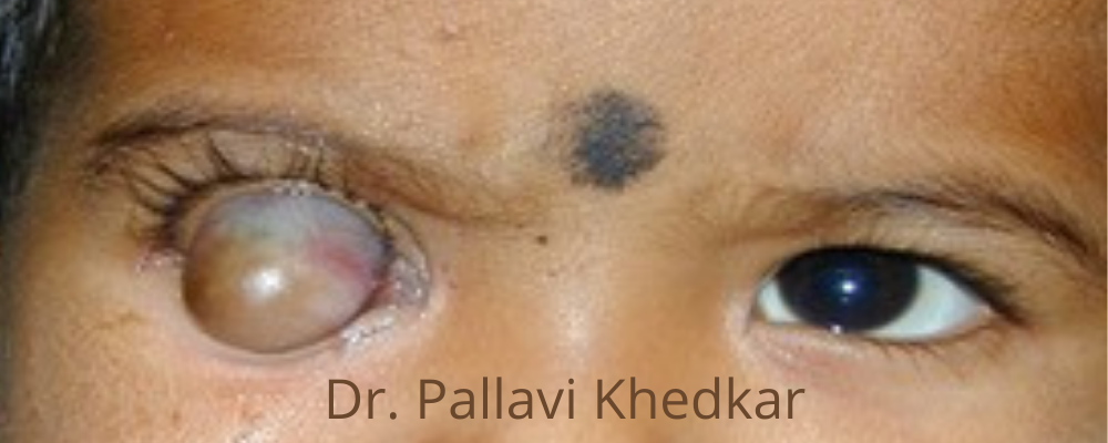 Eye Plastic Surgeon in Aurangabad- Dr. Pallavi Khedkar