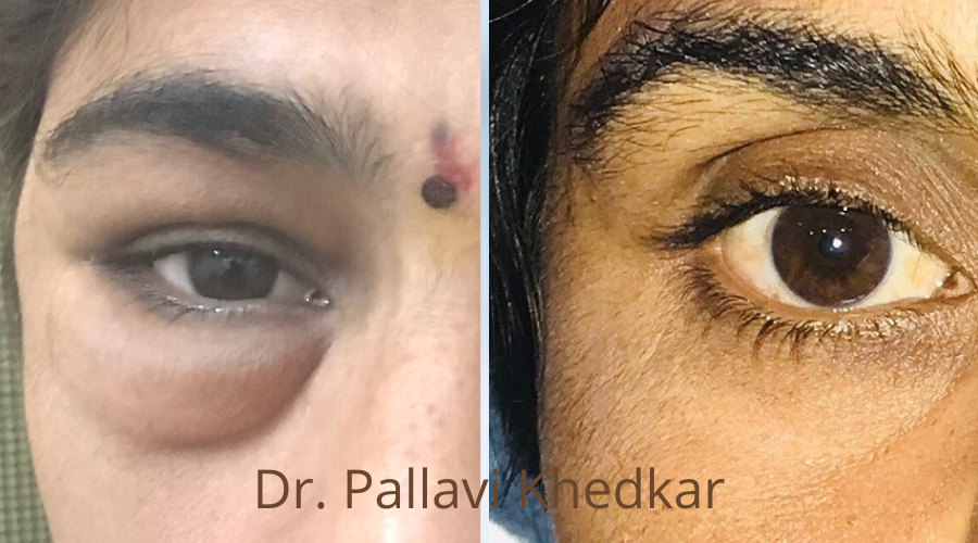 Eye Plastic Surgeon in Aurangabad- Dr. Pallavi Khedkar