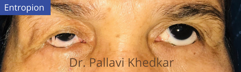 Eye Plastic Surgeon in Aurangabad- Dr. Pallavi Khedkar