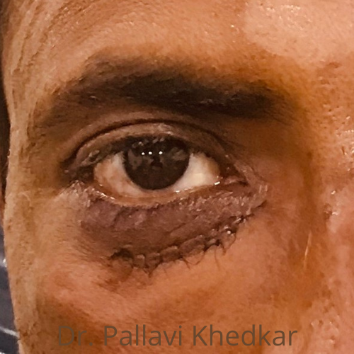 Eye Plastic Surgeon in Aurangabad- Dr. Pallavi Khedkar