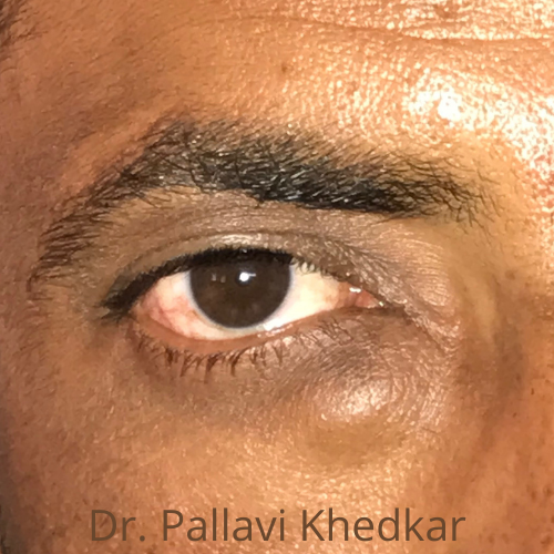 Eye Plastic Surgeon in Aurangabad- Dr. Pallavi Khedkar