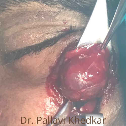 Eye Plastic Surgeon in Aurangabad- Dr. Pallavi Khedkar