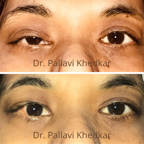 Droopy Eyelids/ Ptosis