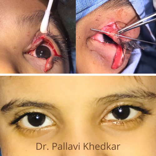 Trauma Around Eye