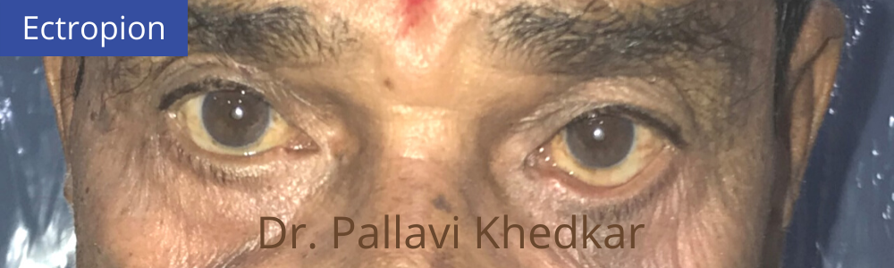 Eye Plastic Surgeon in Aurangabad- Dr. Pallavi Khedkar