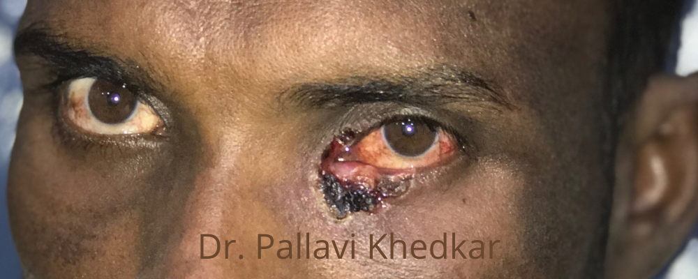 Eye Plastic Surgeon in Aurangabad- Dr. Pallavi Khedkar