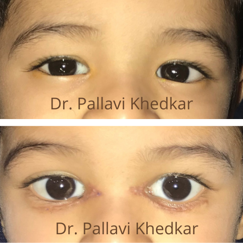 Eyelid Surgeon in Aurangabad- Shree Gajanan Eye Speciality Centre- Dr. Pallavi Khedkar