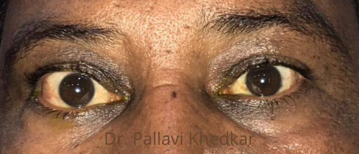 Eye Plastic Surgeon in Aurangabad- Dr. Pallavi Khedkar